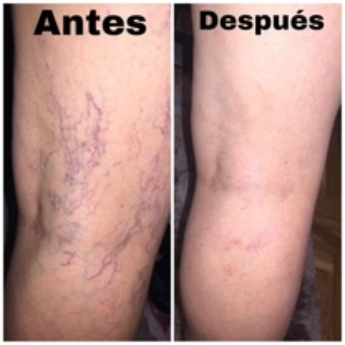 Adiós Venas Spray con envío gratis.