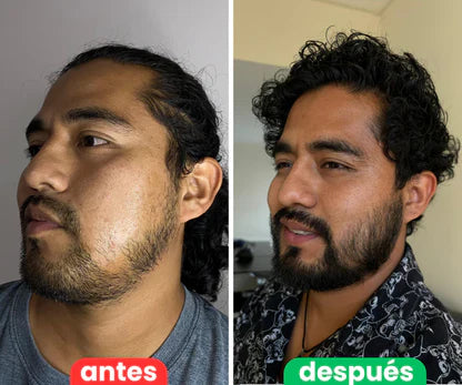 Bálsamo para Crecimiento de Barba Ultra Potente con Minoxidil 20% | 100mL 😍🦁