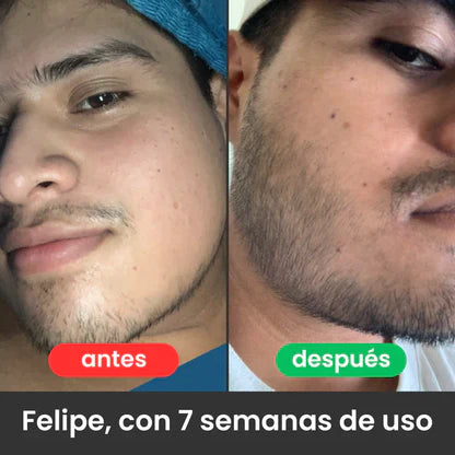 Bálsamo para Crecimiento de Barba Ultra Potente con Minoxidil 20% | 100mL 😍🦁